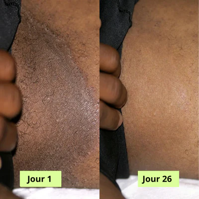 Savon Purifiant Antifongique (Homme & Femme )