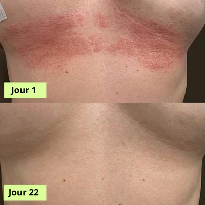 Savon Purifiant Antifongique (Homme & Femme )
